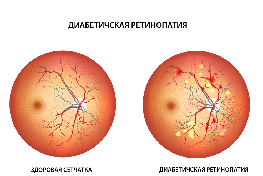 діабетична ретинопатія